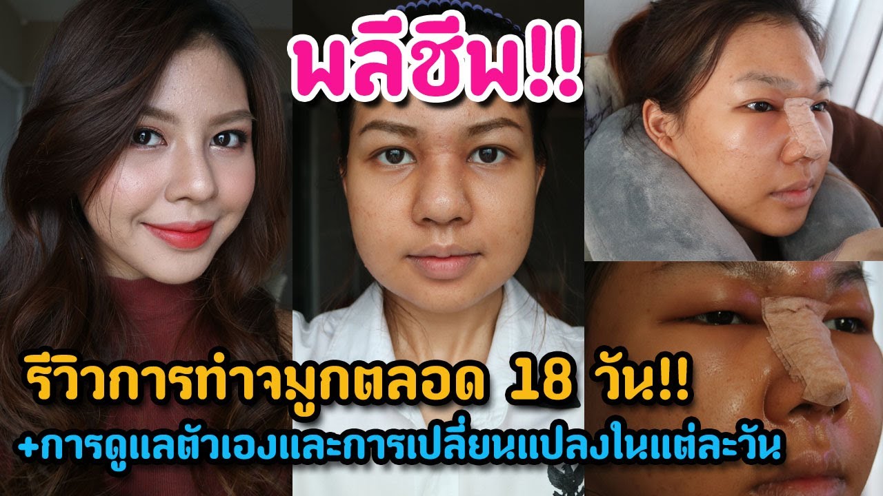 เที่ยวไปกับเมย์#3  รีวิวทำจมูก ดูแลตัวเองและความเปลี่ยนแปลงของจมูกตลอด 18 วัน!! (MAYNESSA)