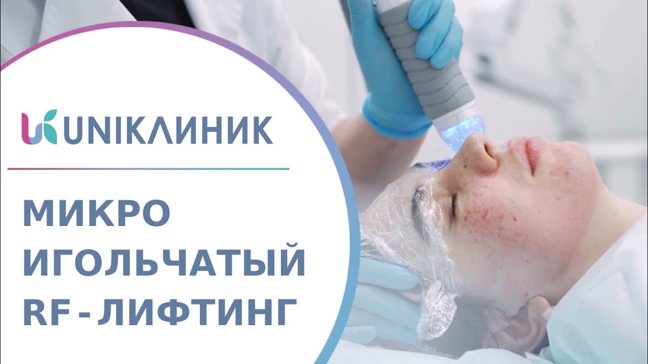 📍 Преимущества микроигольчатого RF-лифтинга на аппарате VIVACE. Микроигольчатый RF-лифтинг Vivace.