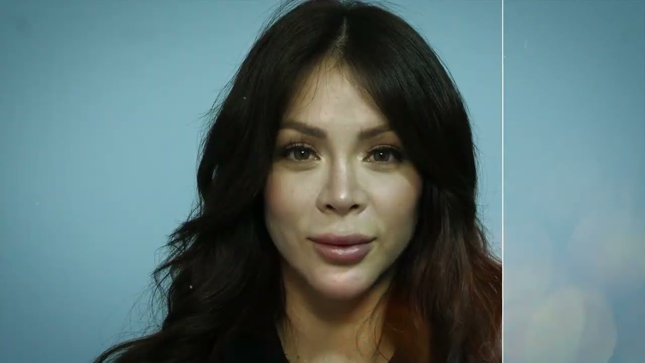 RINOPLASTÍA RECONSTRUTIVA de SHEYLA ROJAS  🤩 LA SHEY 🤩 DR ALBERTO CALVO
