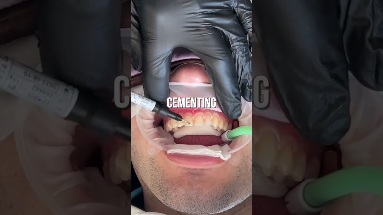 Getting Porcelain Veneers - Inside the Process