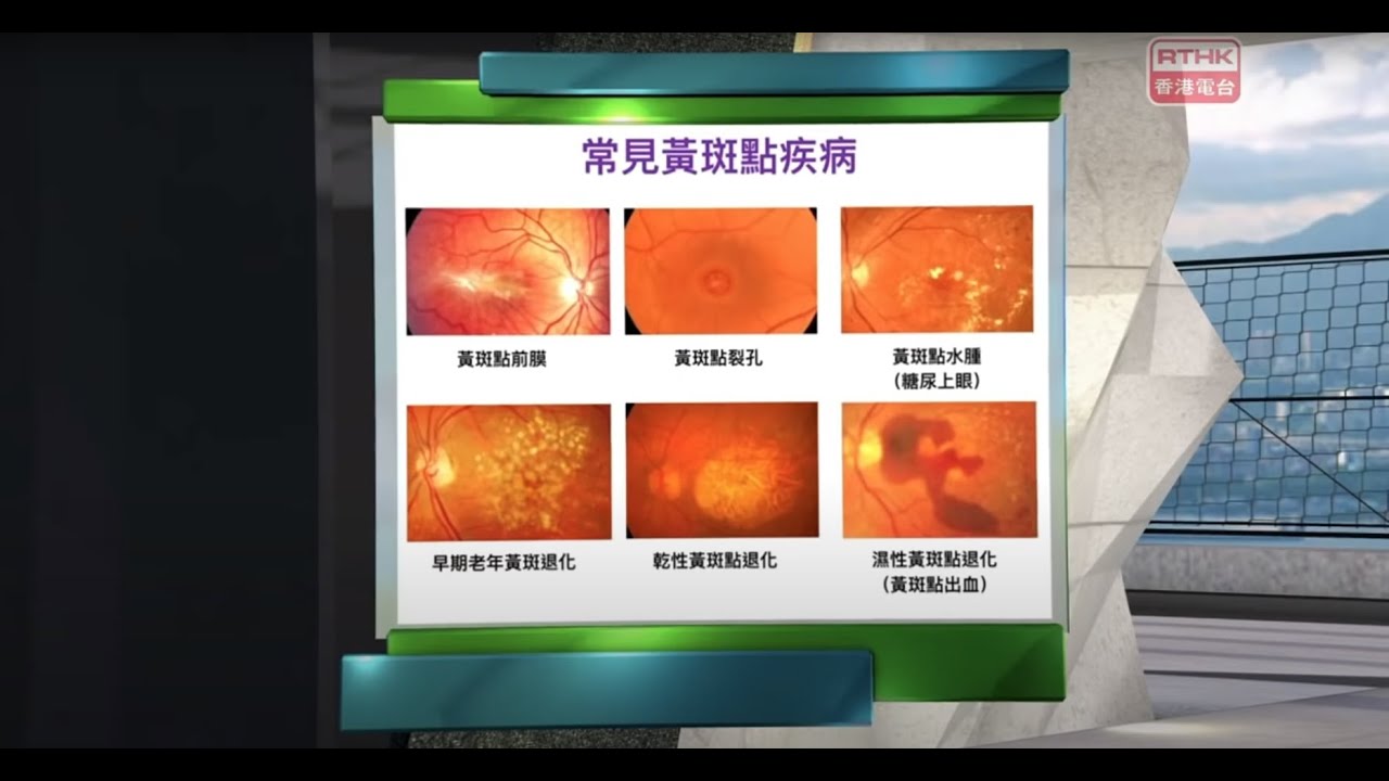 中大眼科 x 精靈一點：陳理佳醫生簡介六大黃斑問題