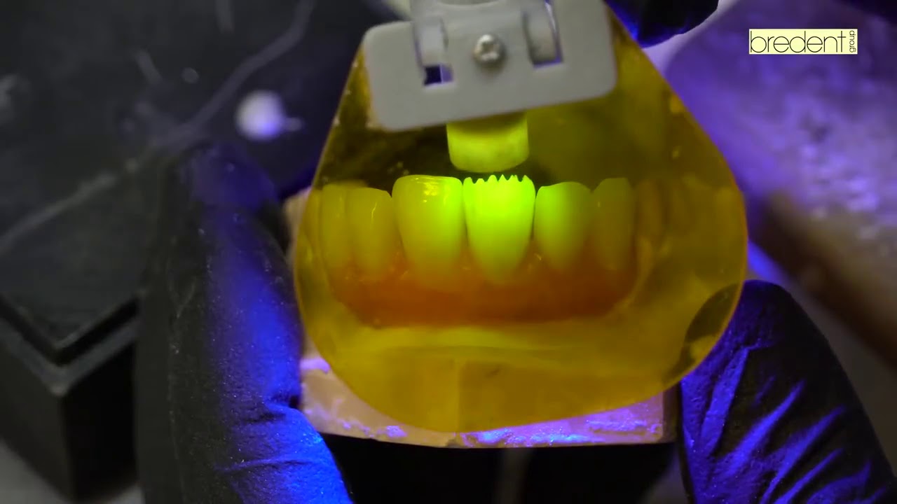 Procesado de una prótesis dental fija