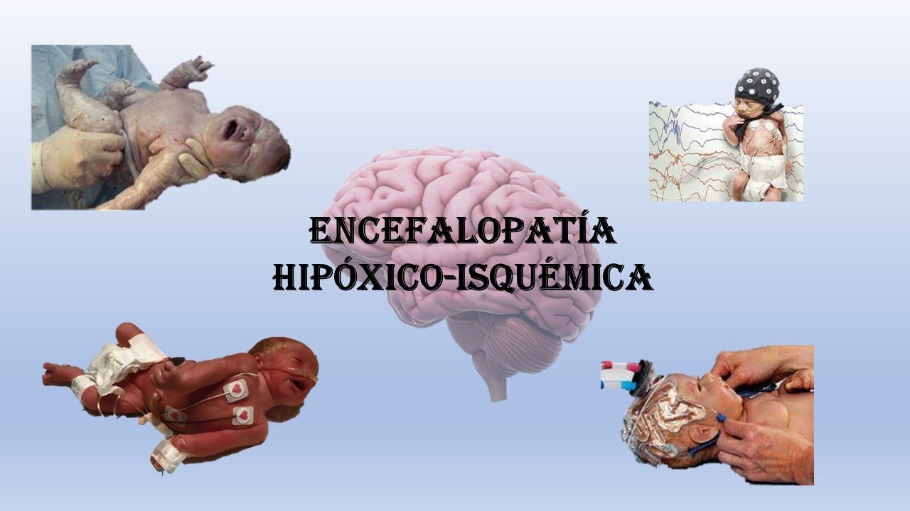 Encefalopatía Hipóxico Isquémica