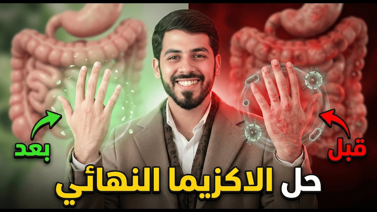 اخيرا! علاج الاكزيما في 5 خطوات فقط