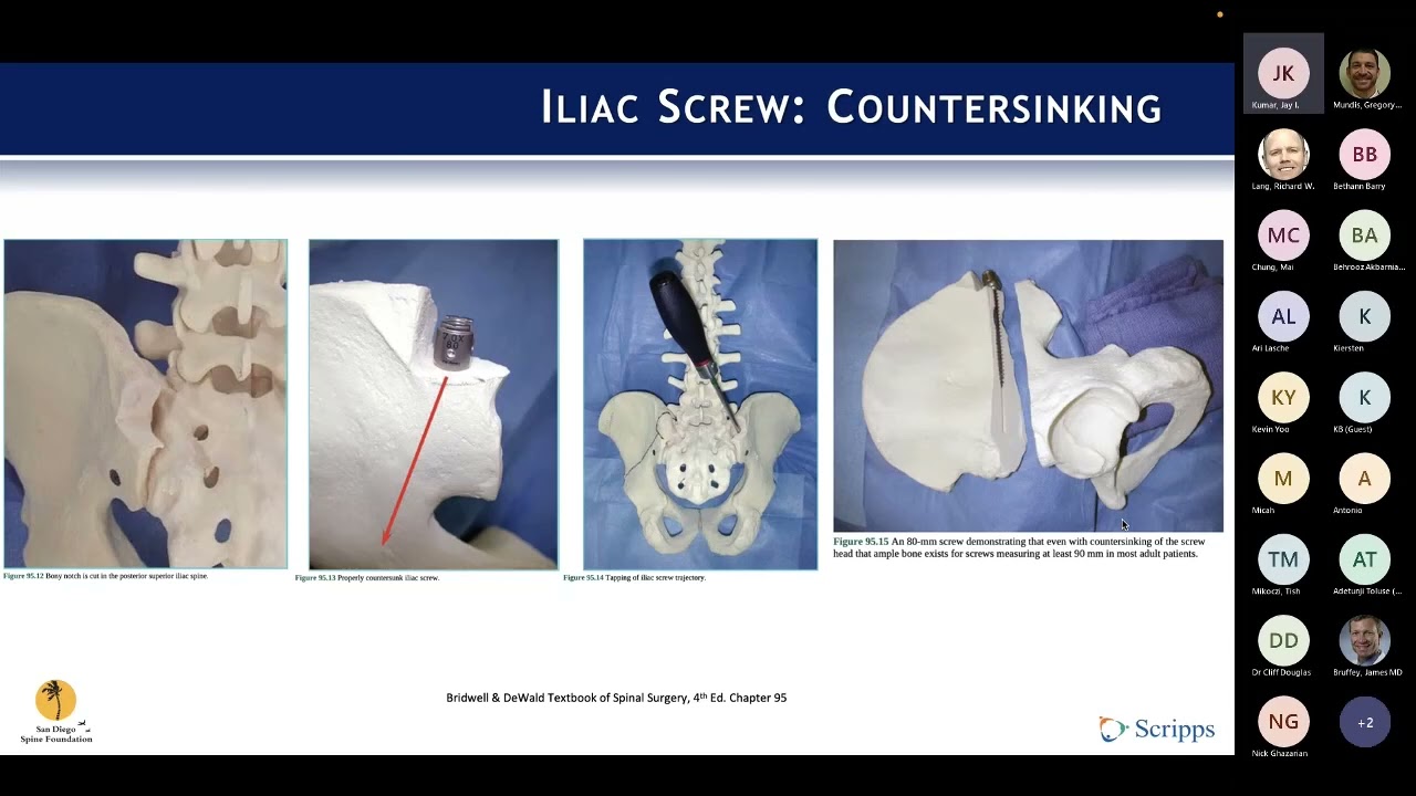 SDSF Conference - Sacropelvic Fixation : Jay Kumar, MD on July 18, 2022