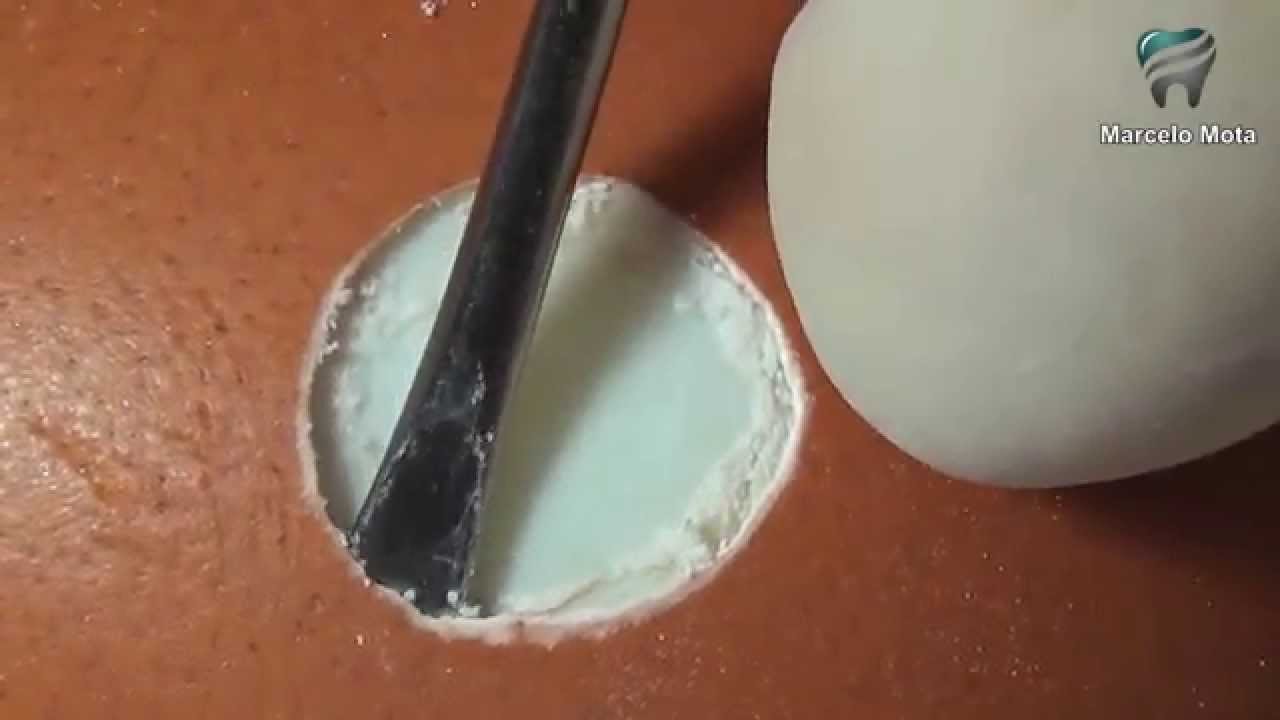 ACESSO AO SEIO MAXILAR (didático com ovo)