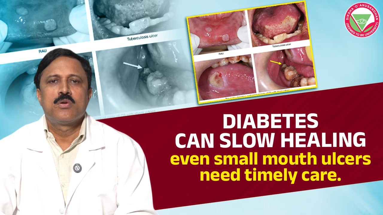 Diabetes can slow healing—even small mouth ulcers need timely care | IDS, SOA University