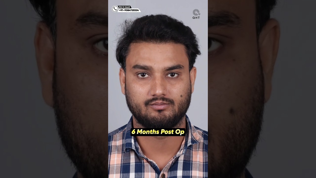 6 Months Hair Transplant Journey #qht #hairtransplant #hairtransplantresults #ytshortsindia #shorts