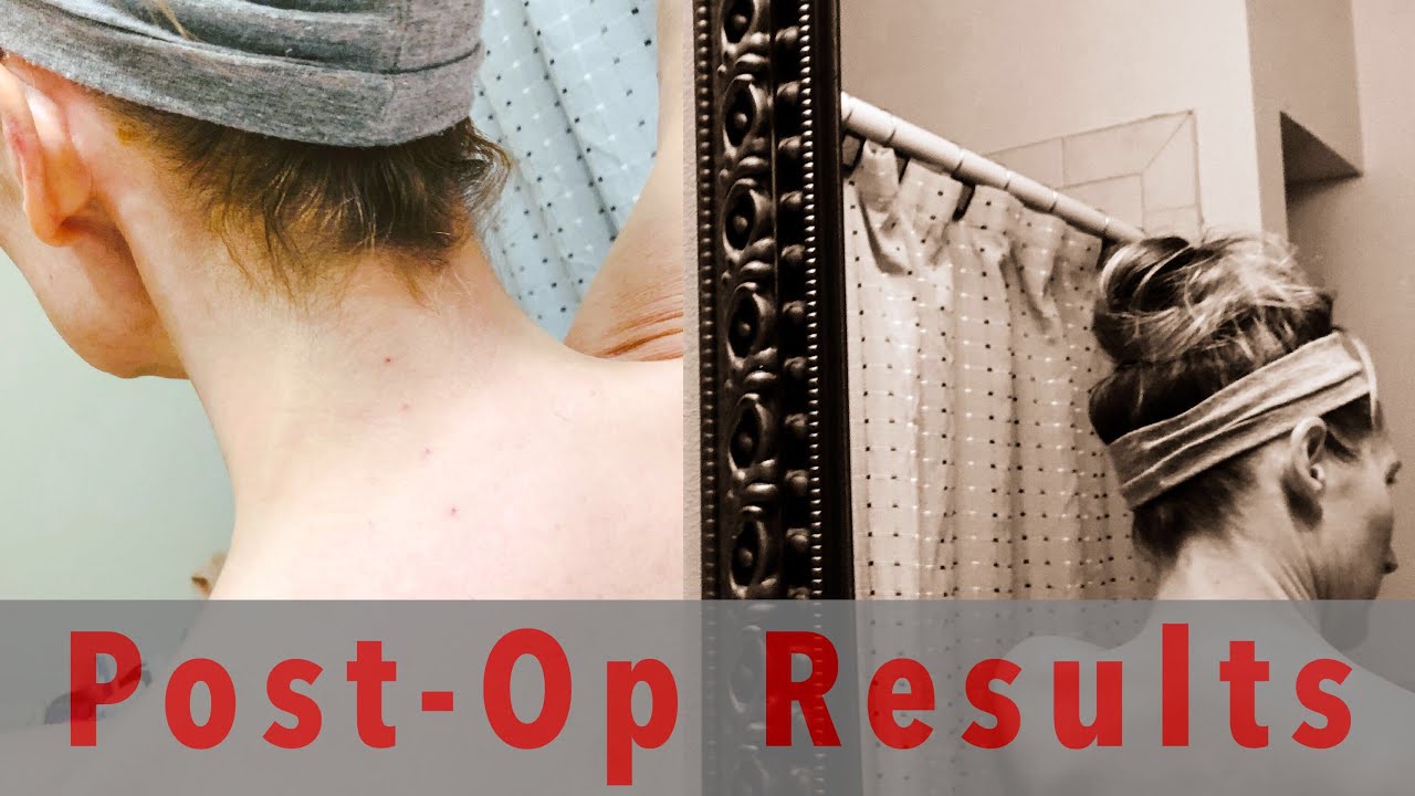 Post Facet Nerve RFA Radiofrequency Ablation | Chronic Neck Pain Caused by Whiplash