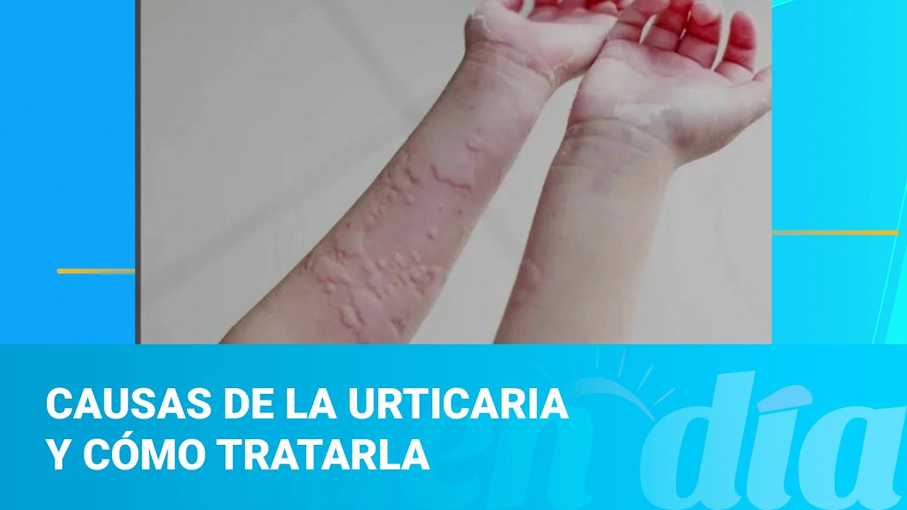 Causas de la urticaria y cómo tratarla