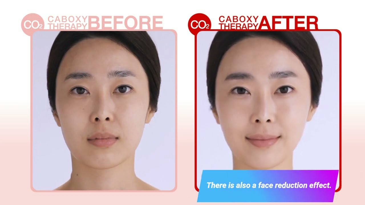 DJ Carboxy Therapy manufactured in Korea - Carborn Therapy Mask Pack.