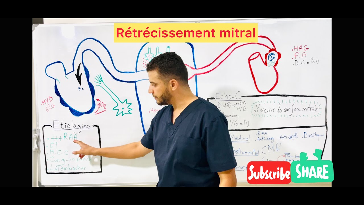 Rétrécissement mitral