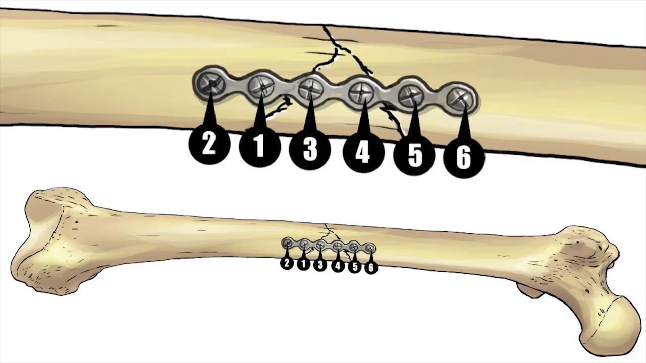 Perform a Simulation Open Reduction and Internal Fixation on a Comminuted Long Bone Fracture