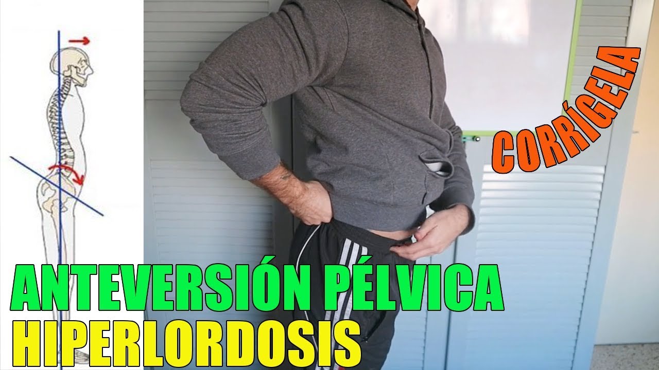 Corrige la ANTEVERSIÓN PÉLVICA e HIPERLORDOSIS en 3 pasos | Higiene Postural