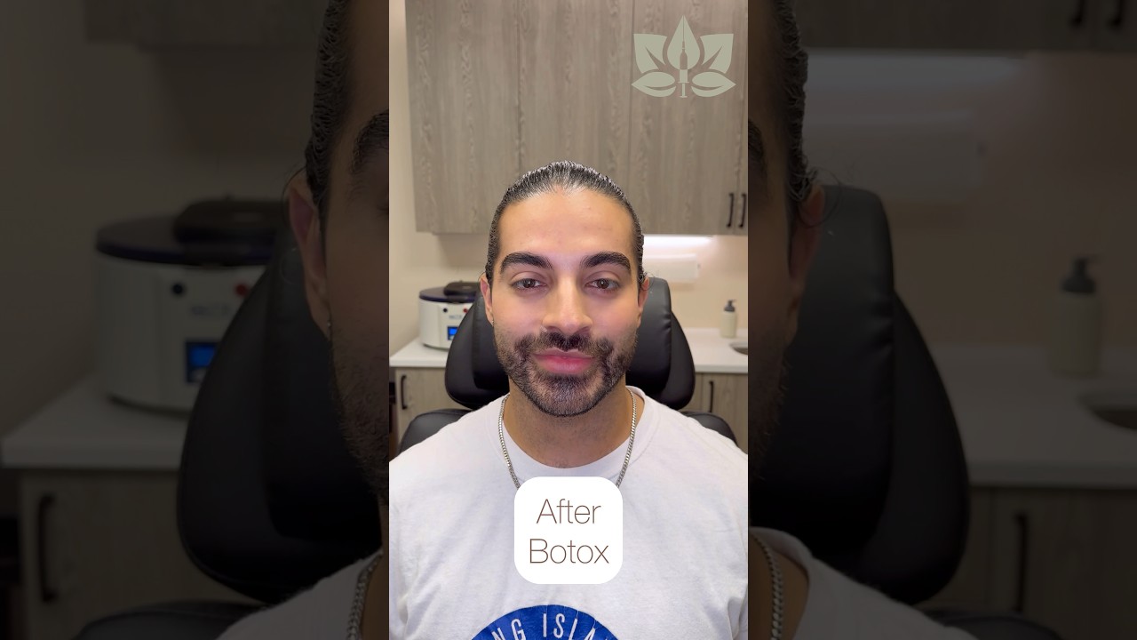 Botox for Men Results | A Younger, Natural Look Without Surgery