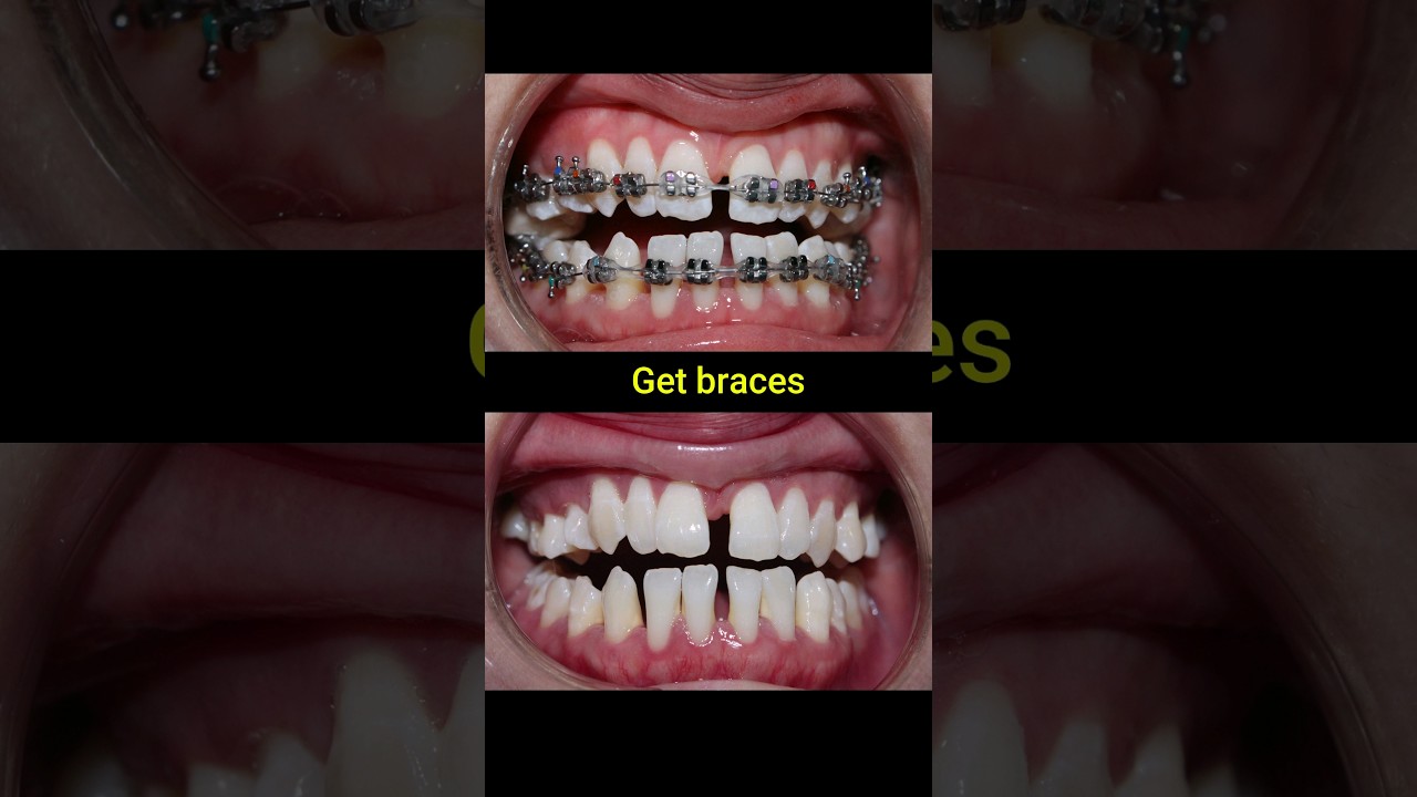 Braces evolution #braces #orthodontist #dentist #dental