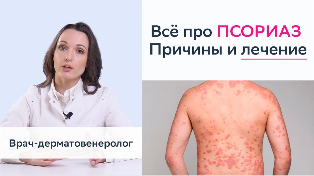 ПСОРИАЗ - причины, подробно о лечении, признаки и симптомы псориаза