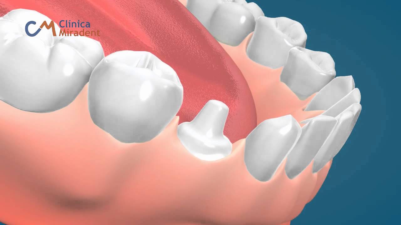 Pr&oacute;tesis Coronas alternativas en materiales