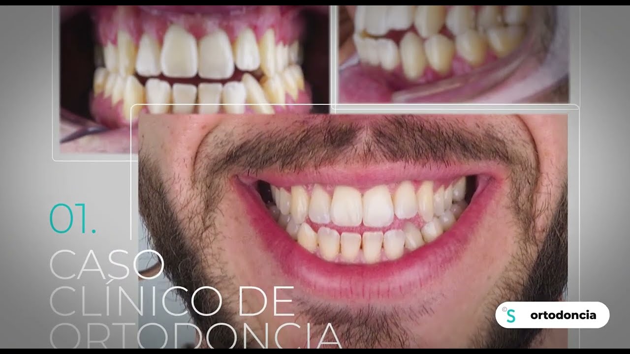 Mordida Abierta, Cruzada y Clase III · Caso clínico de Ortodoncia