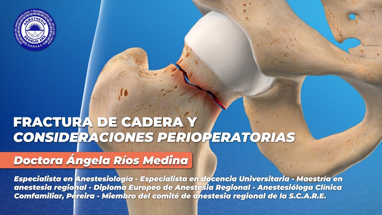 Fractura de Cadera y Consideraciones Perioperatorias