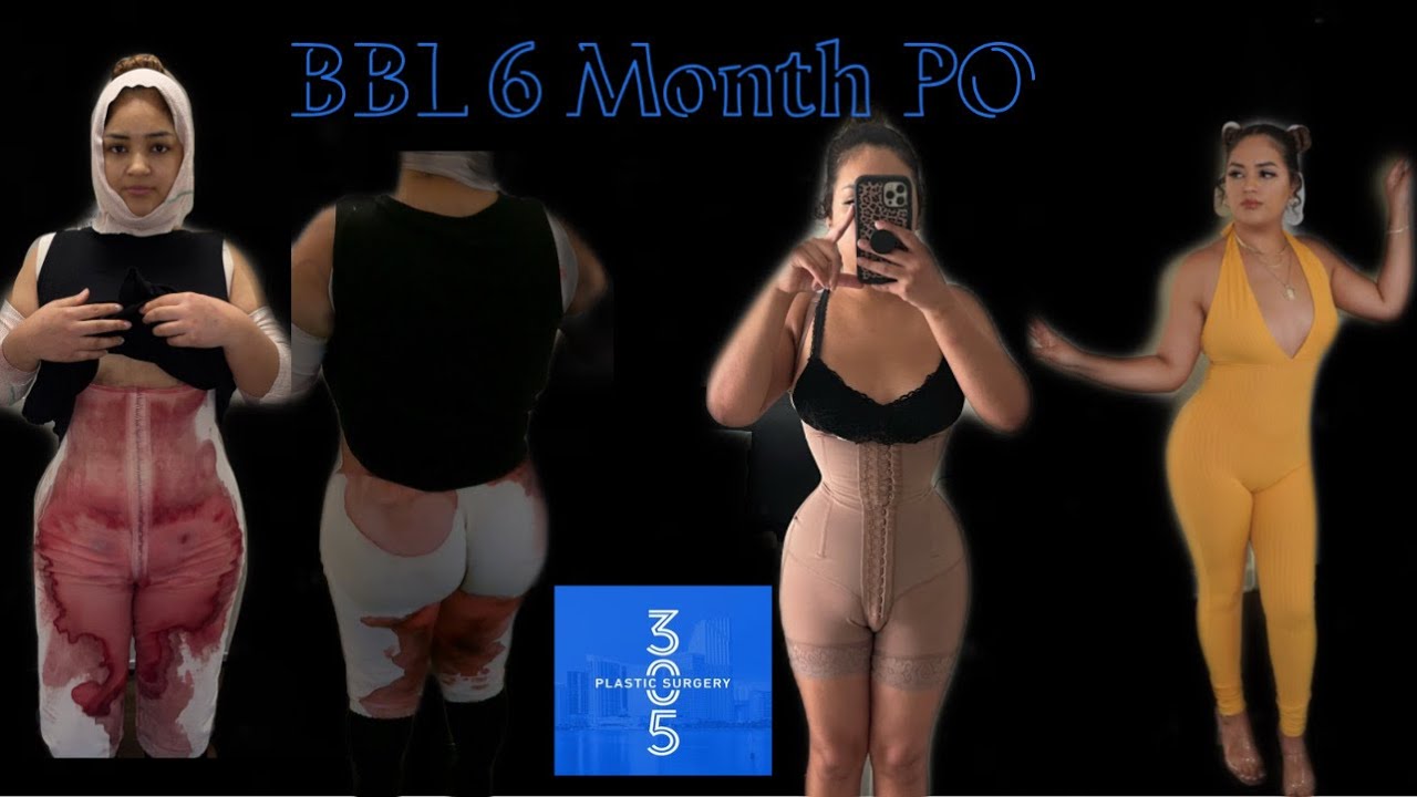 BBL | 6 Month BBL Update | 305 Plastic Surgery | BBL Regrets | Results, Doctor, Post op care