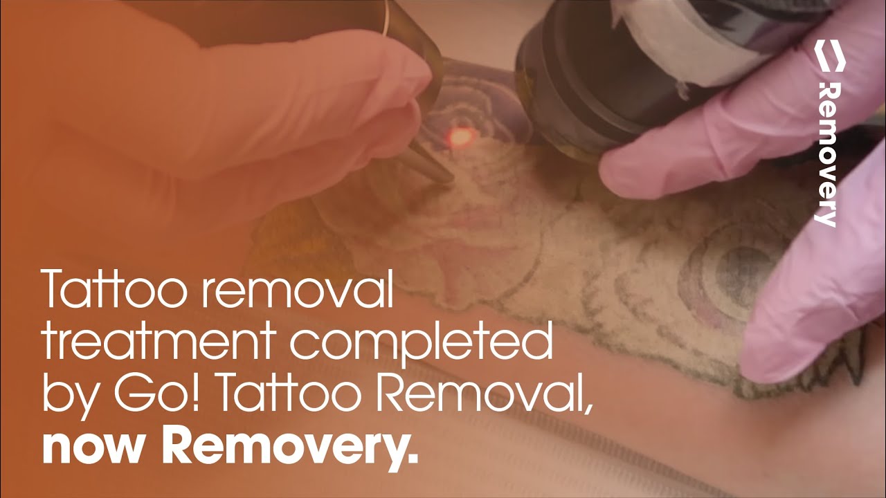 Laser Tattoo Removal Of An Owl | Go Tattoo Removal, Now Removery