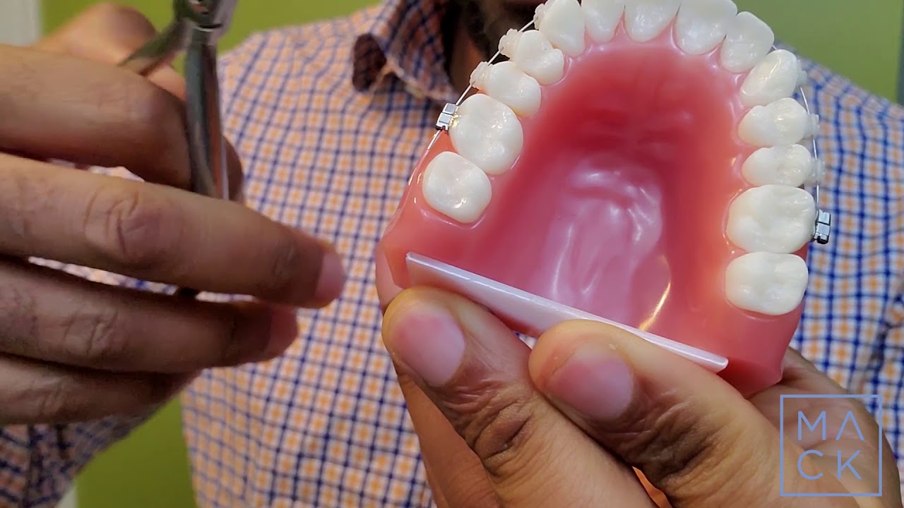 Pokey Wires, Broken braces, and How to Fix Them
