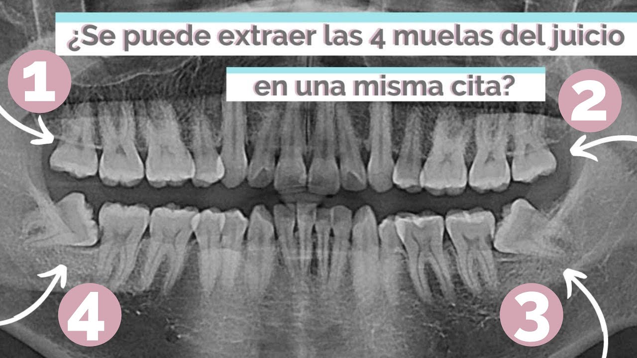 ¿SE PUEDEN EXTRAER LAS 4 MUELAS DEL JUICIO EN UNA MISMA CITA?