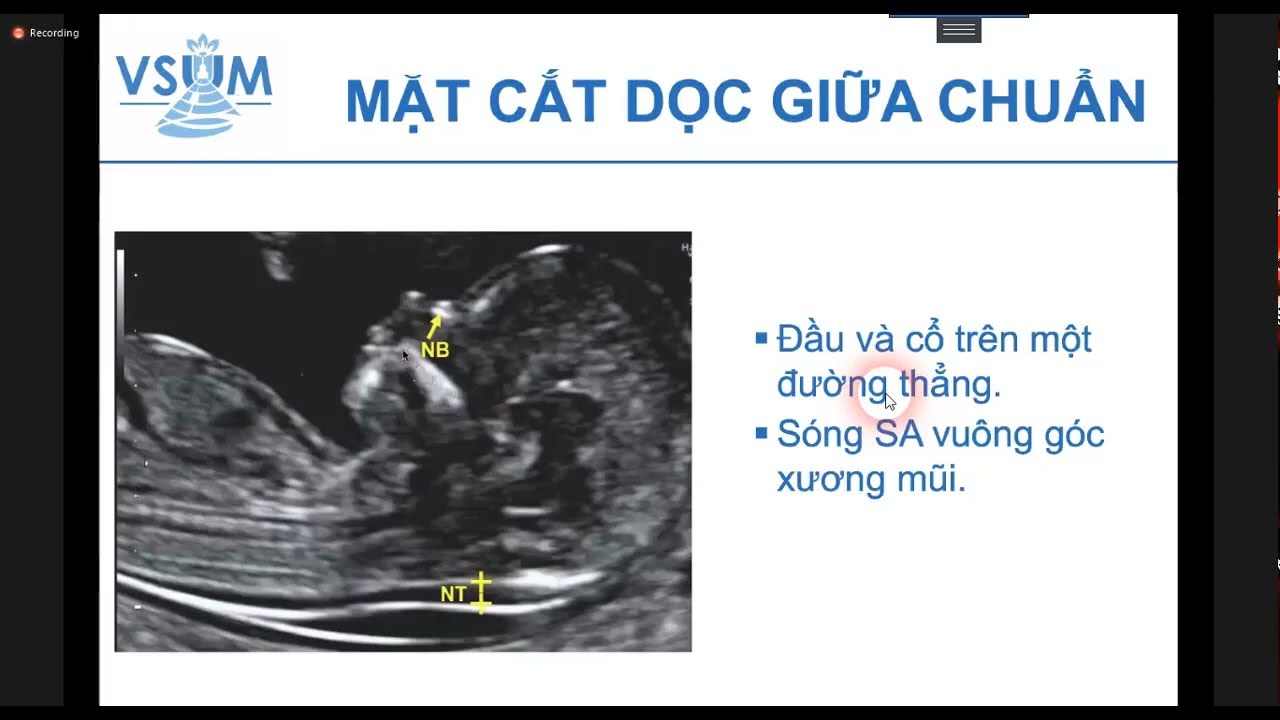 03 Vai trò sàng lọc của siêu âm quý 1 trong thời đại tiền sản không xâm lấn - ThS.BS. Hà Tố Nguyên