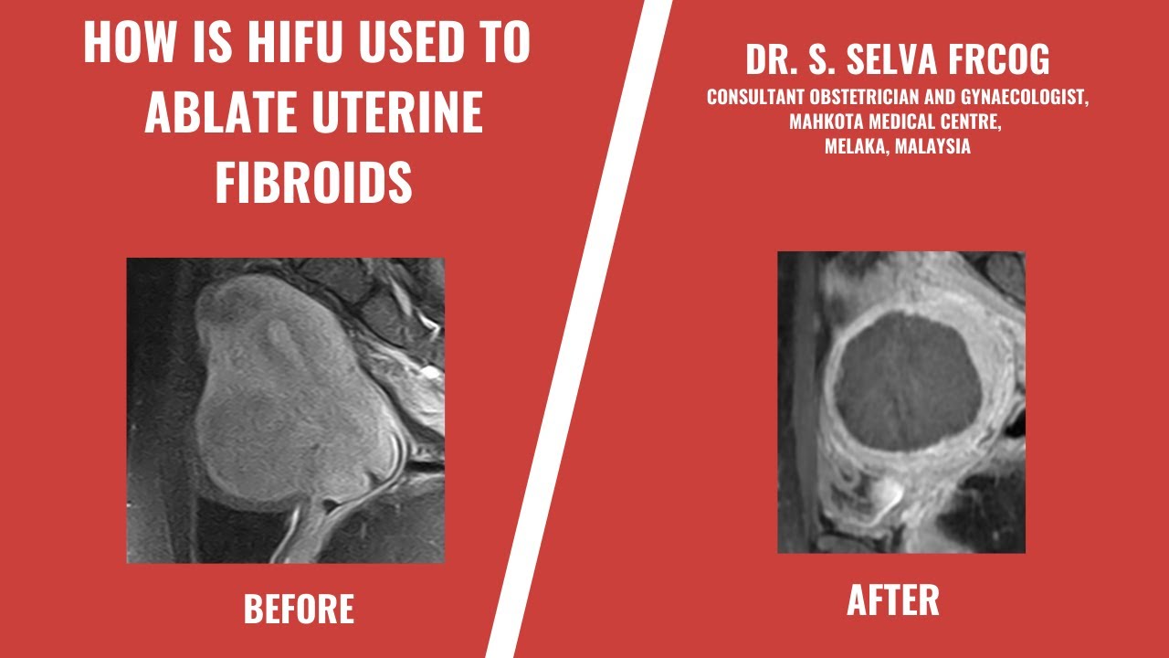 How is HIFU used to ablate Uterine Fibroid