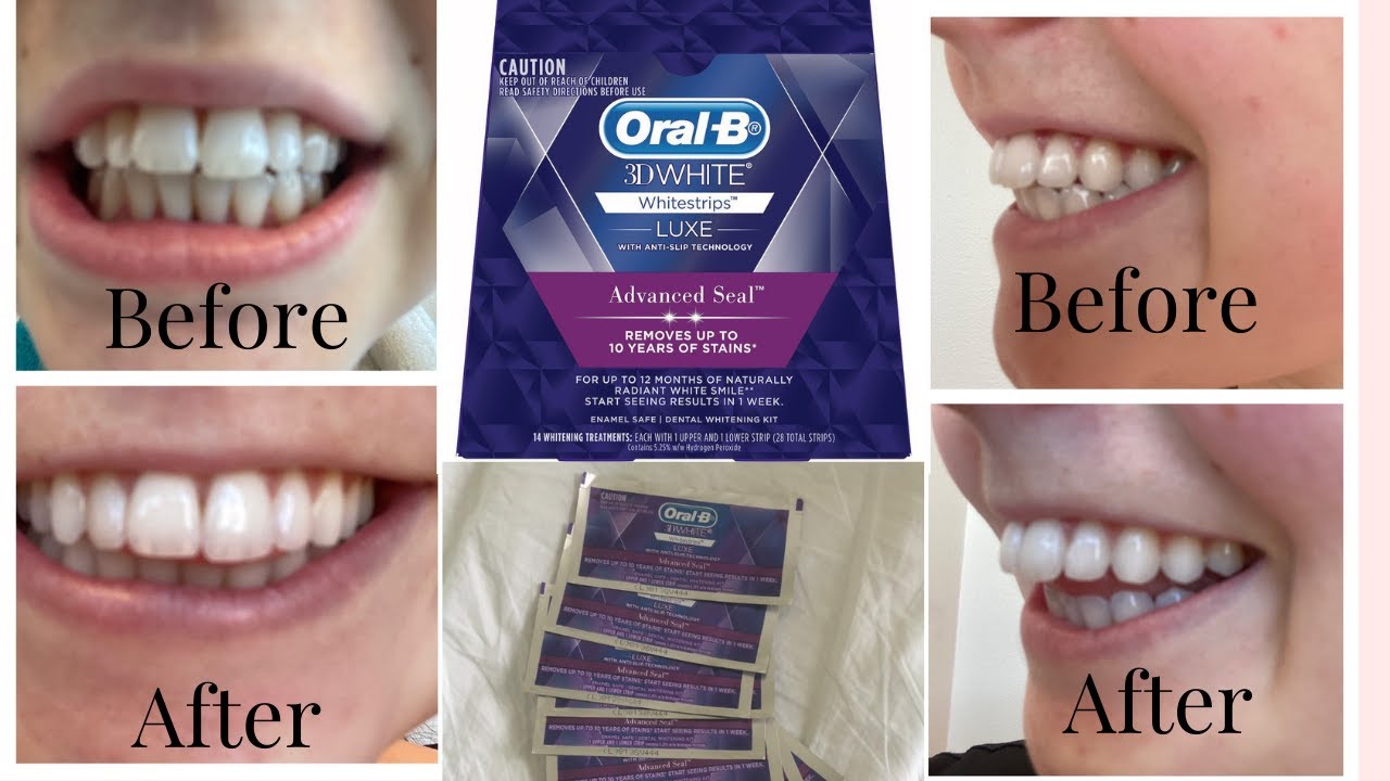 Отбеливающие полоски Oral-B // Честный обзор // Отбеливание зубов // Быстрое отбеливание зубов // Crest