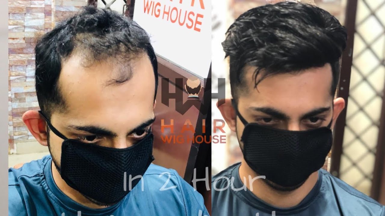 Watch till end , Natural looking hair Replacement , best hair patch in Delhi & Chandigarh 9953384242