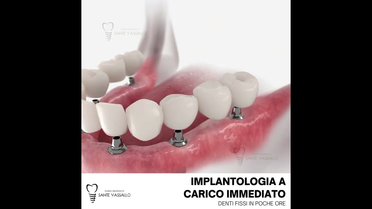 Implantologia a carico immediato - Denti fissi in poche ore #viral #subscribe #mrbeast