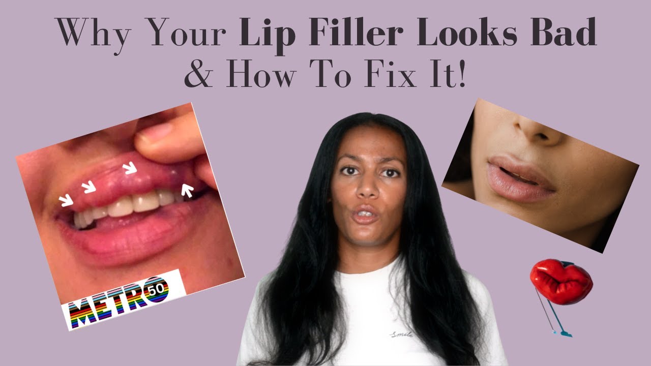 What Makes Lip Filler Look Bad | How To Fix Lip Filler Problems | Top Lip Filler Tips