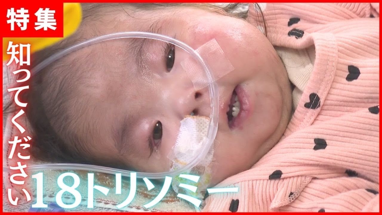 【1分1秒の奇跡】染色体異常18トリソミーの赤ちゃん｜命と向き合う写真展