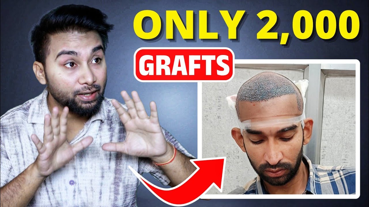 Best Hair Transplant Technique In India In 2026 🔥🔥🔥 Best Results Guaranteed 