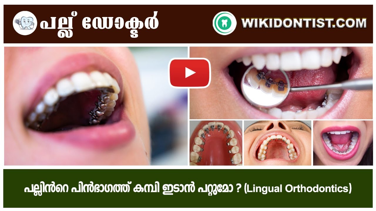 പല്ലിൻറെ പിൻഭാഗത്ത്  കമ്പി ഇടാൻ പറ്റുമോ ? Lingual orthodontics.