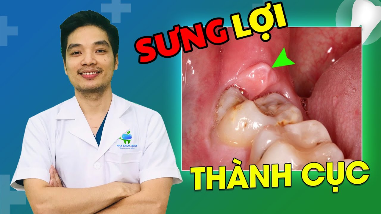 Tại Sao Sưng Lợi Thành Cục Ở Chỗ Răng Hàm? Cách Xử Lý Thông Minh