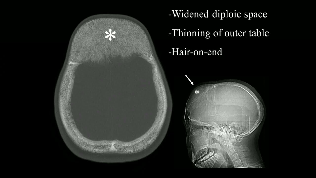 Imaging Hemoglobinopathies