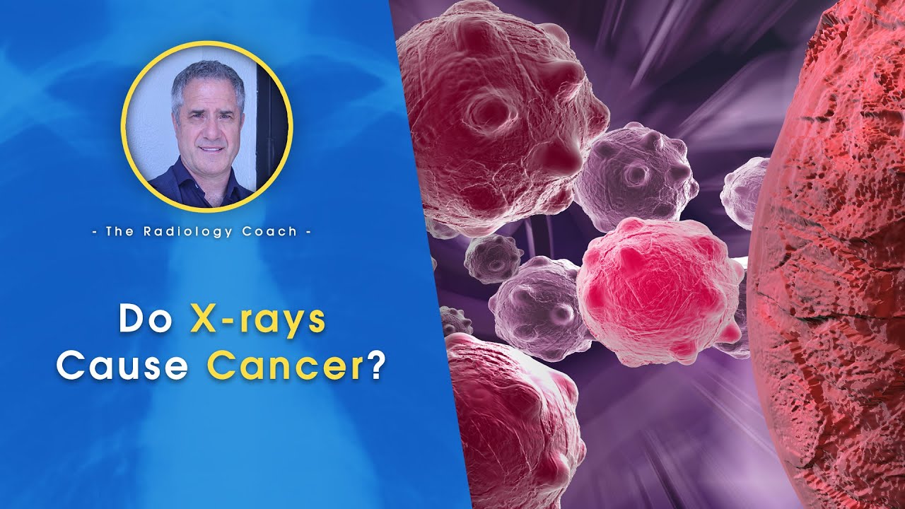 Do X rays CAUSE CANCER??