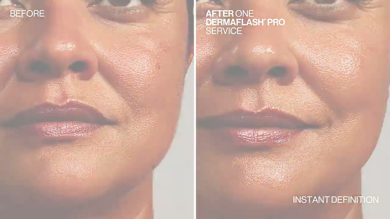 DERMAFLASH PRO Info Video