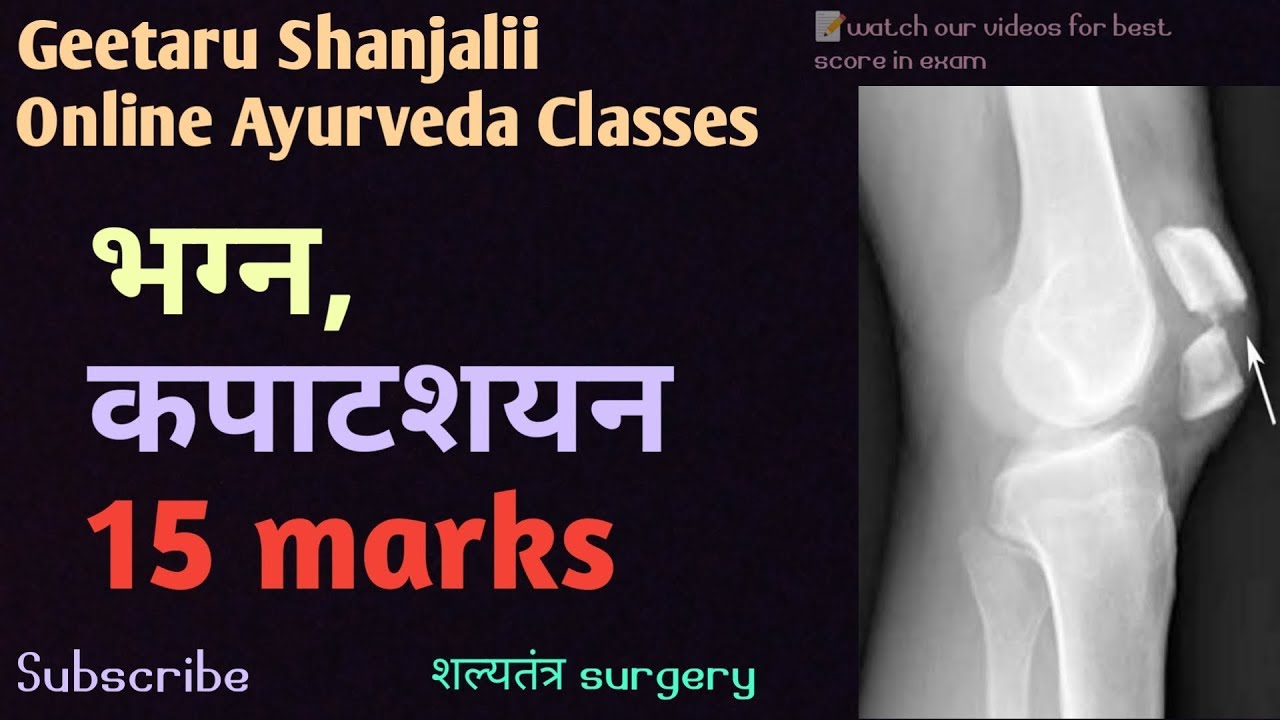 अस्थिभग्न asthi bhagan by Geetaru Shanjalii #BAMS #shalytantra #Gitaru #Ayurveda #UGfinalyearlecture