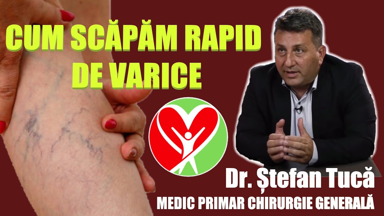 Cum scăpăm rapid de varice | Dr. Ștefan Tucă - Medic Primar Chirurgie Generală