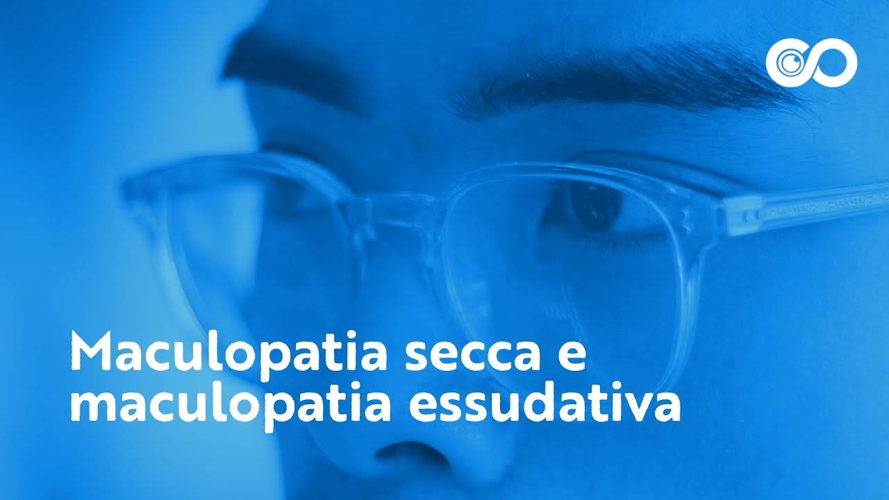Maculopatia secca e maculopatia essudativa