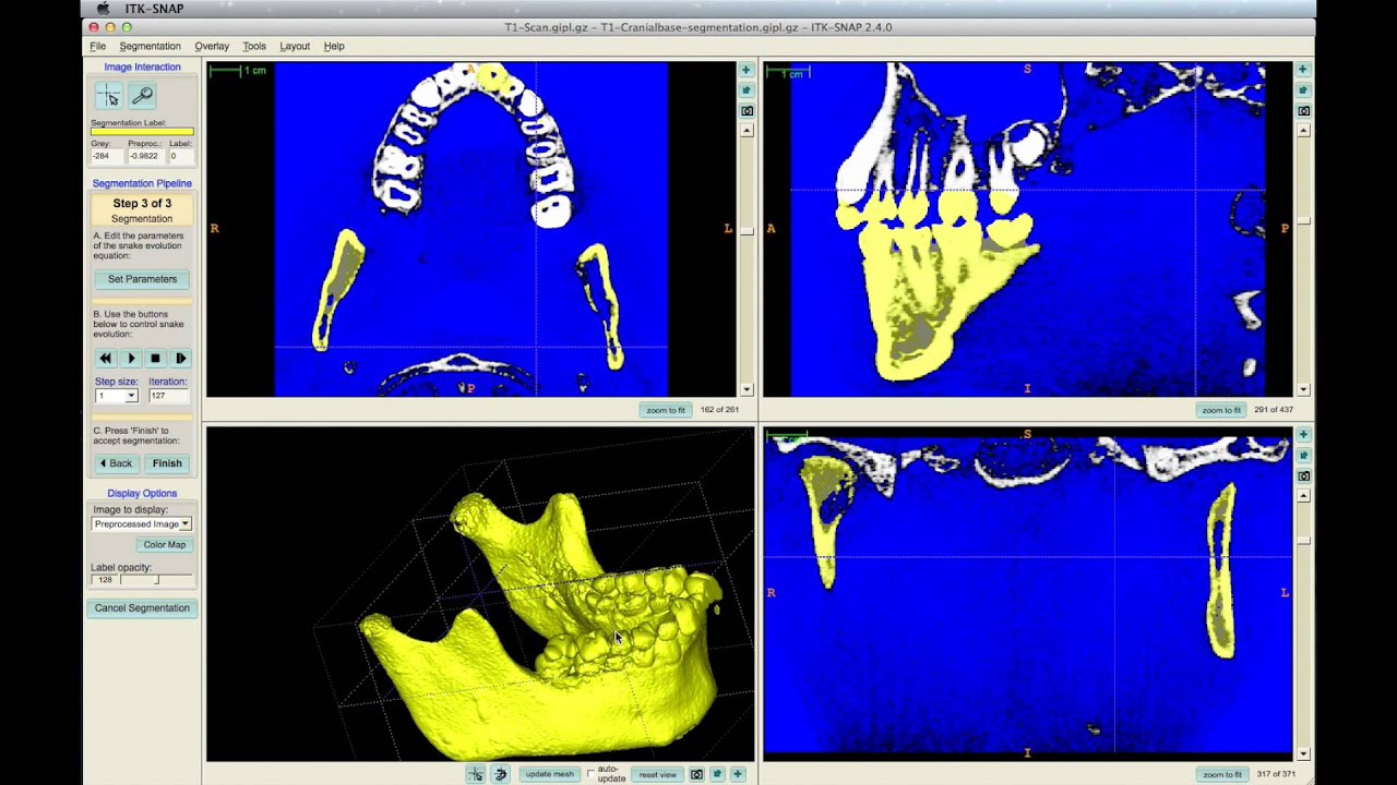 3E: Construct the Segmentation of the Mandible