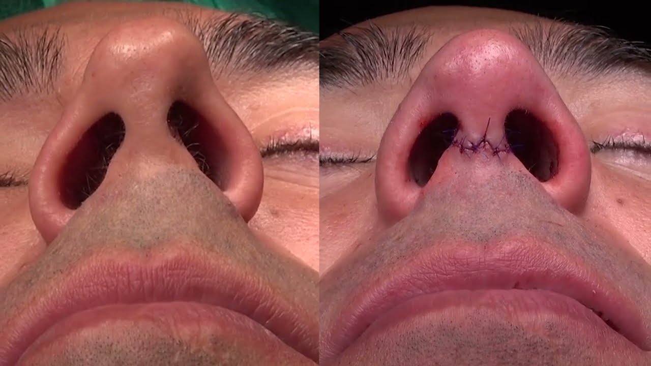 ¡HOY OS TRAEMOS OTRO CASO DE RINOPLASTIA MASCULINA!