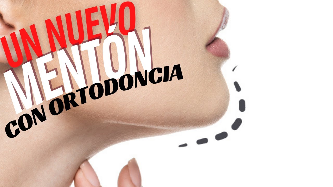 ¿COMO TENER UN NUEVO MENTÓN SIN CIRUGÍA? / AUMENTO DE MENTÓN CON BRACKETS