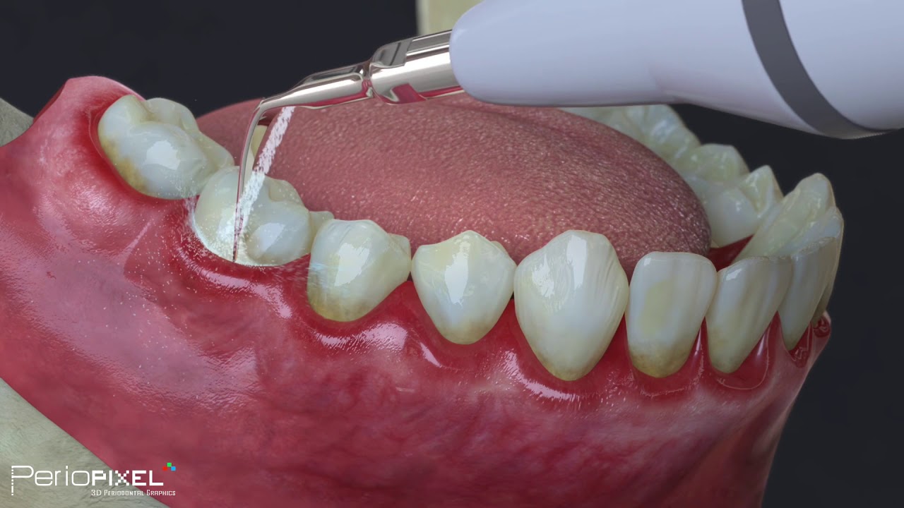 Ako prebieha čistenie zubov u dent&aacute;lnej hygeničky