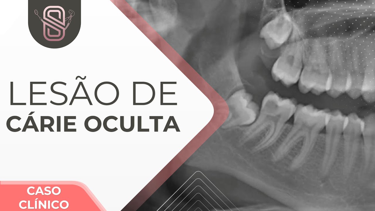 Lesão de cárie oculta - Caso clínico