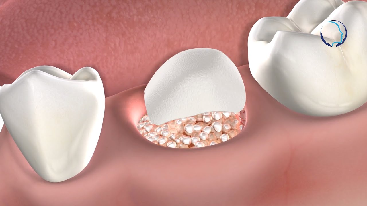 Bone Grafting in Groton, MA